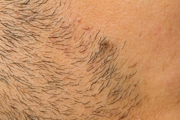 Above: Dealing with ingrown hairs