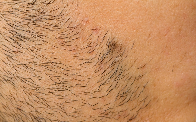 Above: Dealing with ingrown hairs
