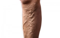 Why do men overlook their varicose veins? (Photo: Audie/Shutterstock)