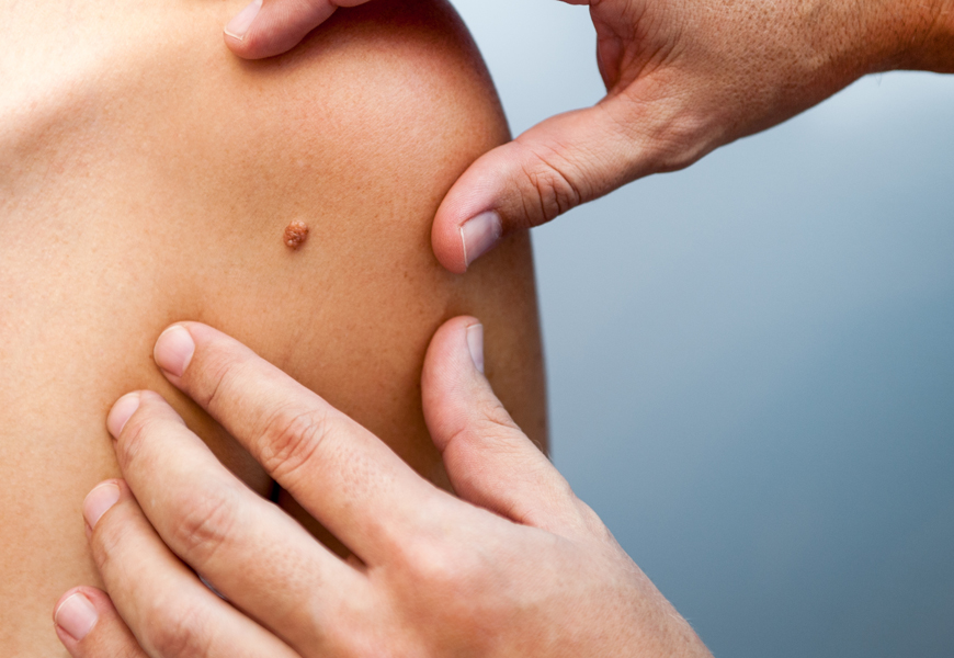 Above: How to know when that mole is more than it appears to be