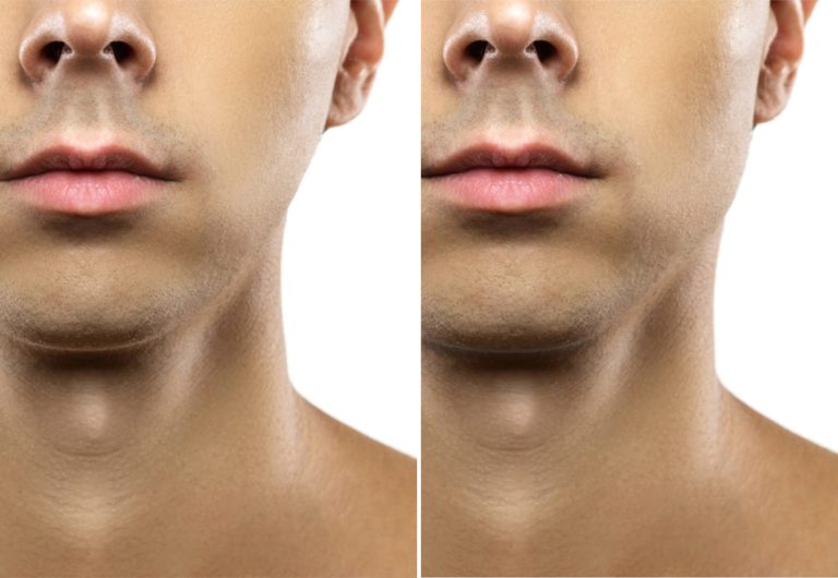 Thumbpulling: Can Your Thumbs Help Shape A Better Jawline? - AmongMen